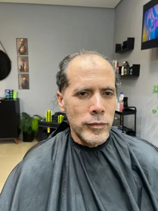 Antes prótese capilar cliente 1