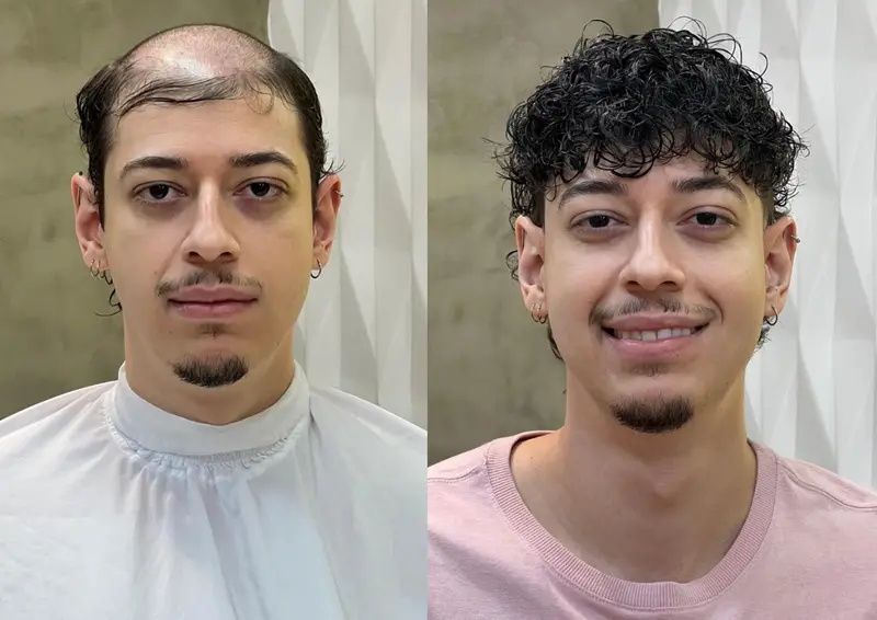 Antes e depois prótese capilar cliente 10 - Transformação completa