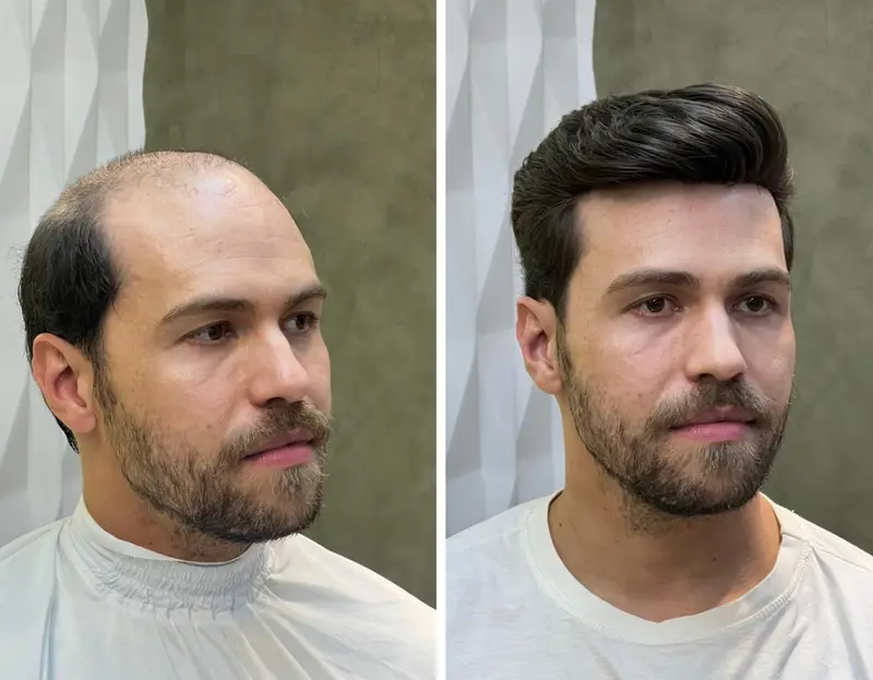 Antes e depois prótese capilar cliente 11 - Transformação completa