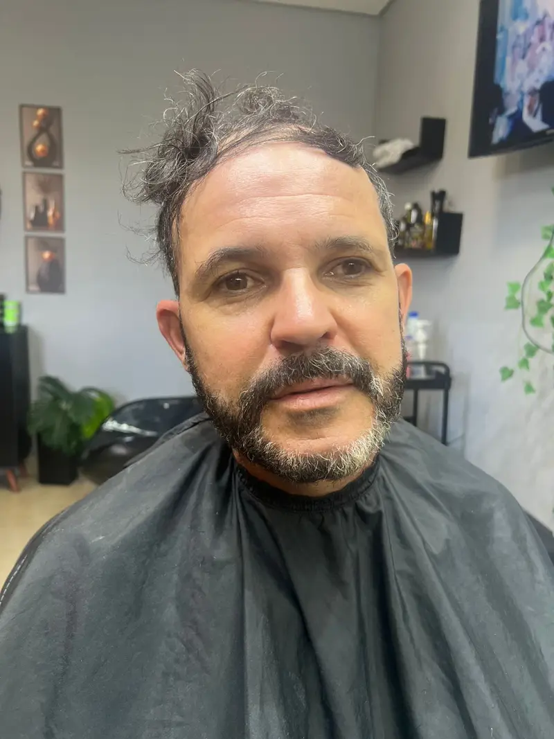 Antes da prótese capilar - Cliente 2