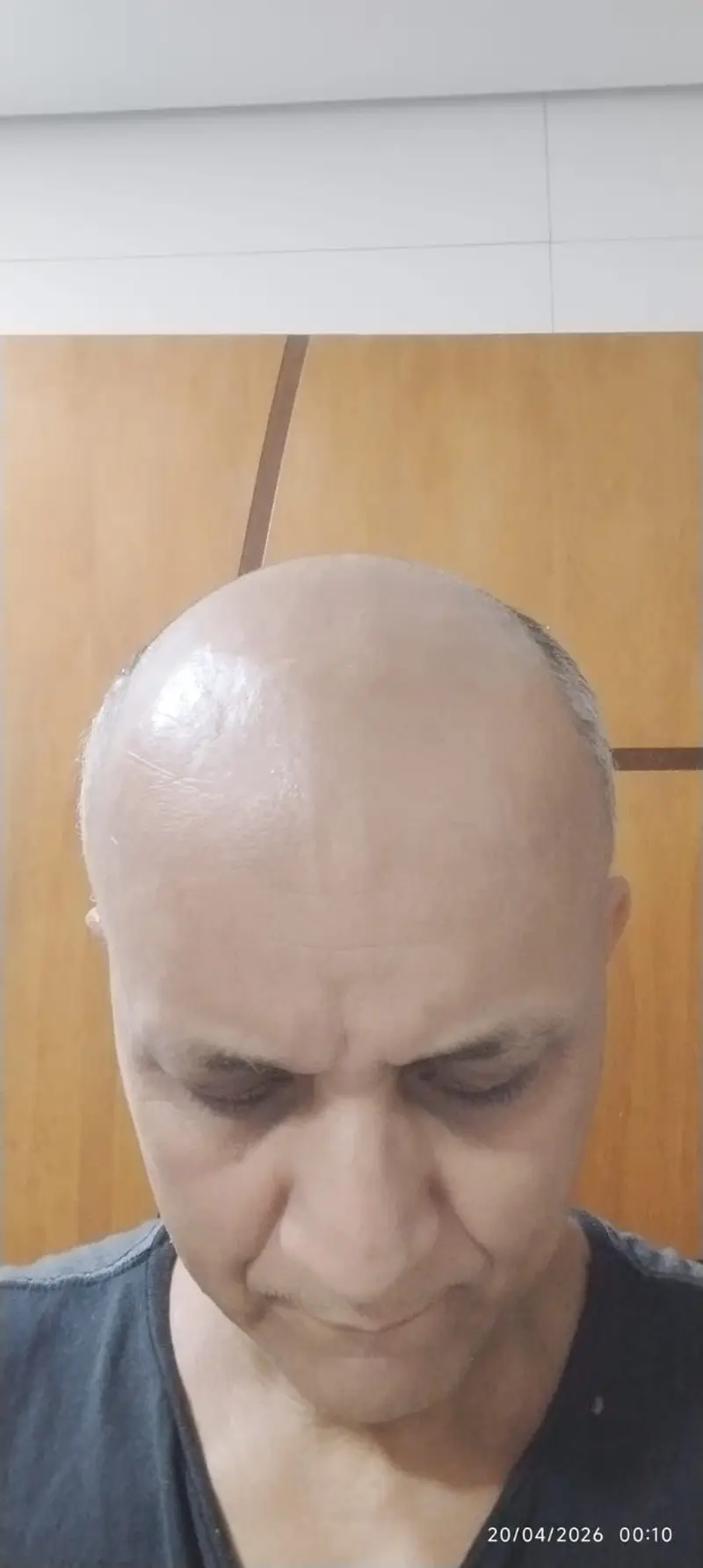 Antes da prótese capilar - Cliente 5