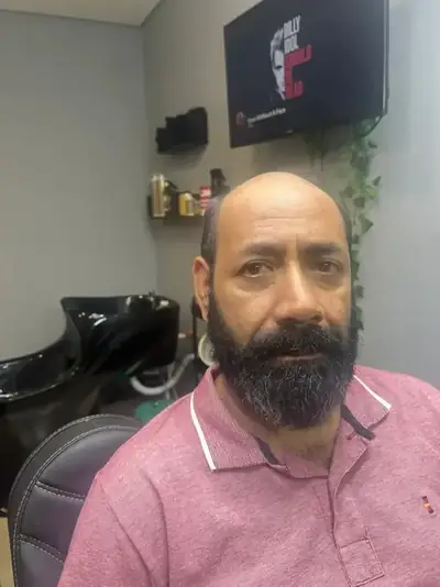 Antes prótese capilar cliente 6