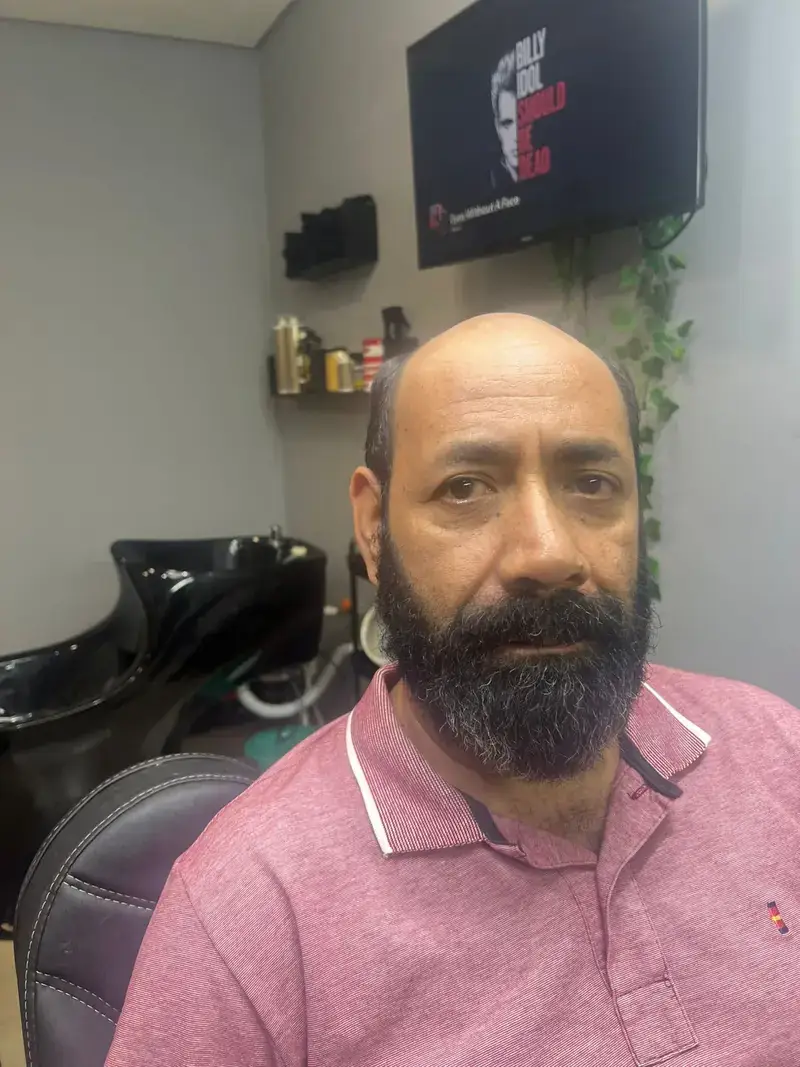 Antes da prótese capilar - Cliente 6