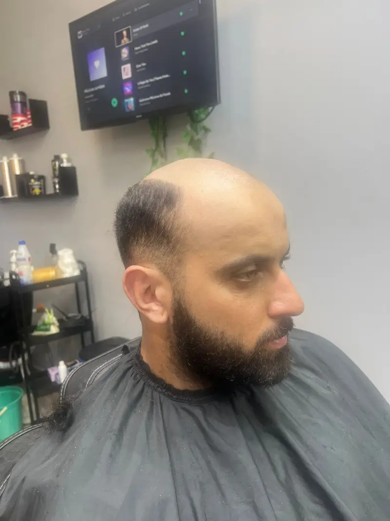 Antes da prótese capilar - Cliente 7