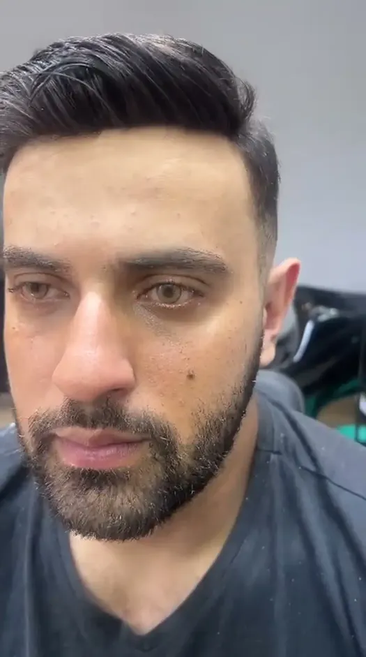 Depois prótese capilar cliente 7