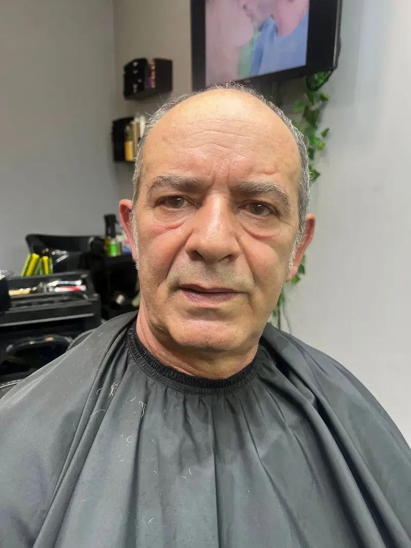 Antes da prótese capilar - Cliente 8