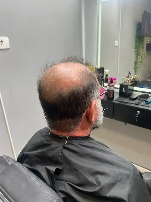 Antes prótese capilar cliente 9