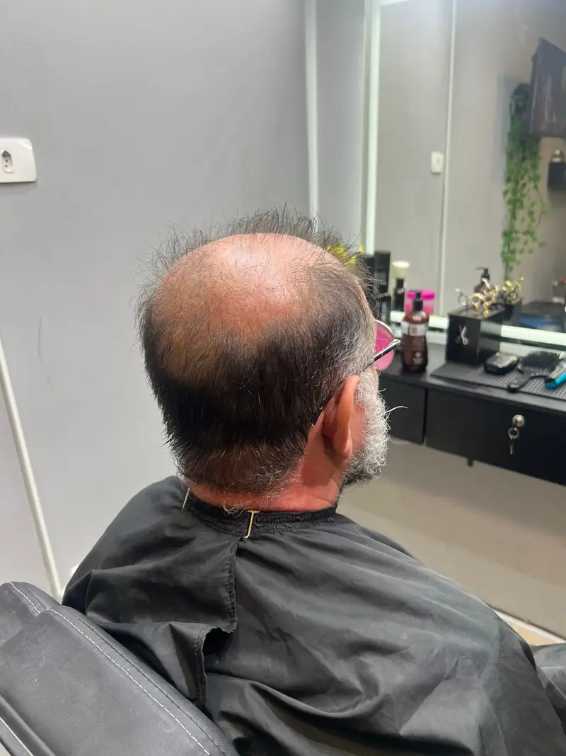 Antes da prótese capilar - Cliente 9